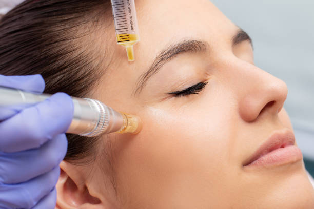 photo site skin needling